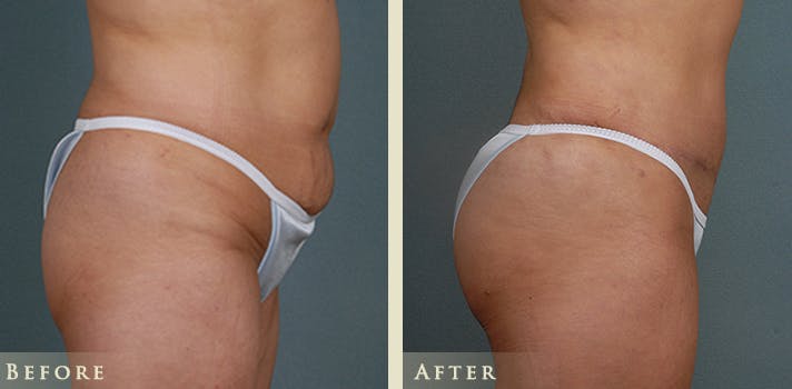 Brazilian Butt Lift Before & After Gallery - Patient 210943 - Image 3