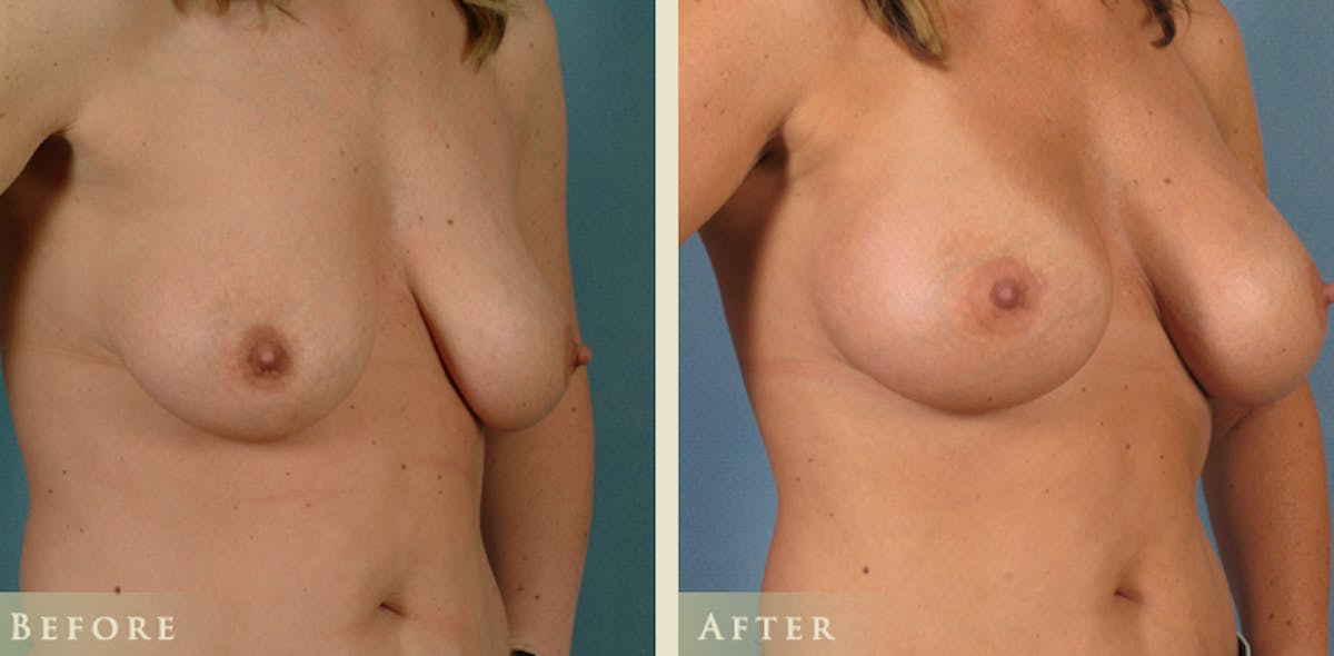 Breast Augmentation with Saline Implants Before & After Gallery - Patient 283016 - Image 2