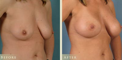 Breast Augmentation Before & After Gallery - Patient 248268 - Image 2