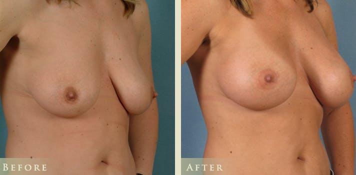 Breast Augmentation Before & After Gallery - Patient 248268 - Image 2