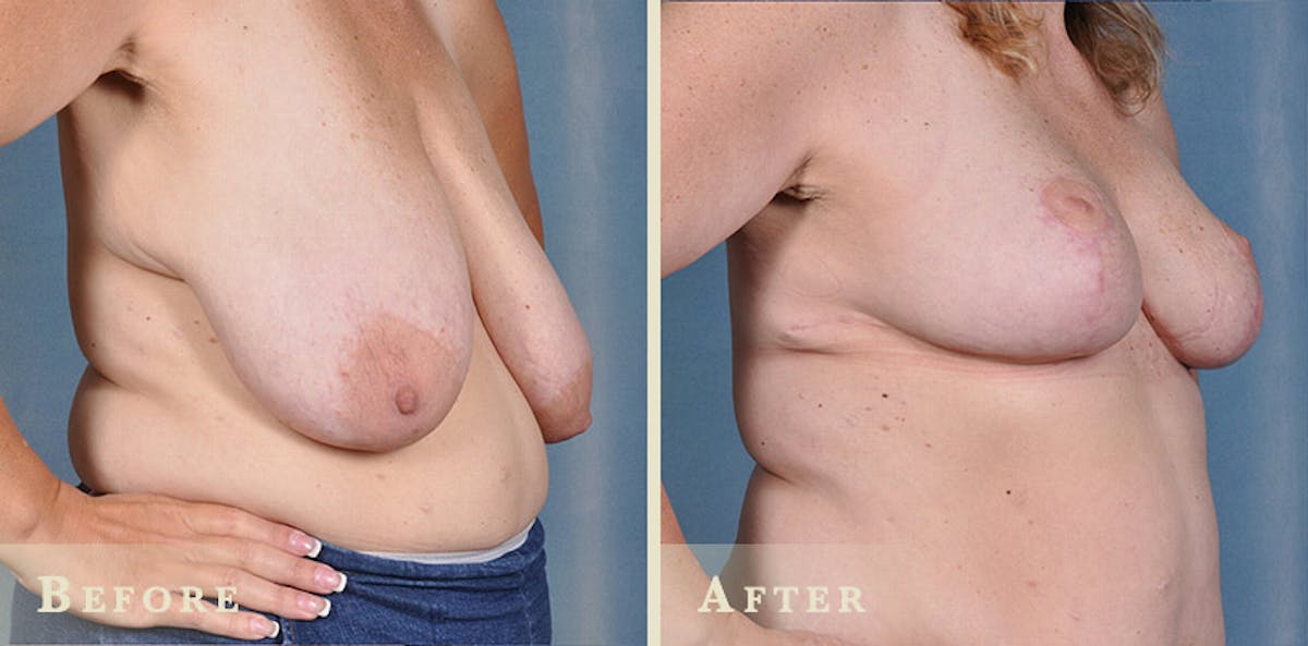 Breast Lift and Reduction Before & After Gallery - Patient 422628 - Image 2