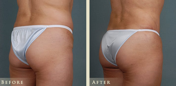 Brazilian Butt Lift Before & After Gallery - Patient 210943 - Image 4