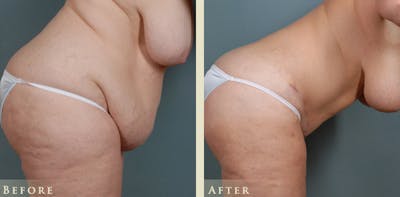 Tummy Tuck Before & After Gallery - Patient 175154 - Image 5