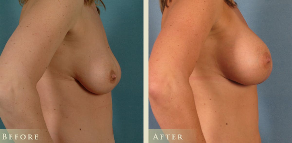 Breast Augmentation with Saline Implants Before & After Gallery - Patient 283016 - Image 3