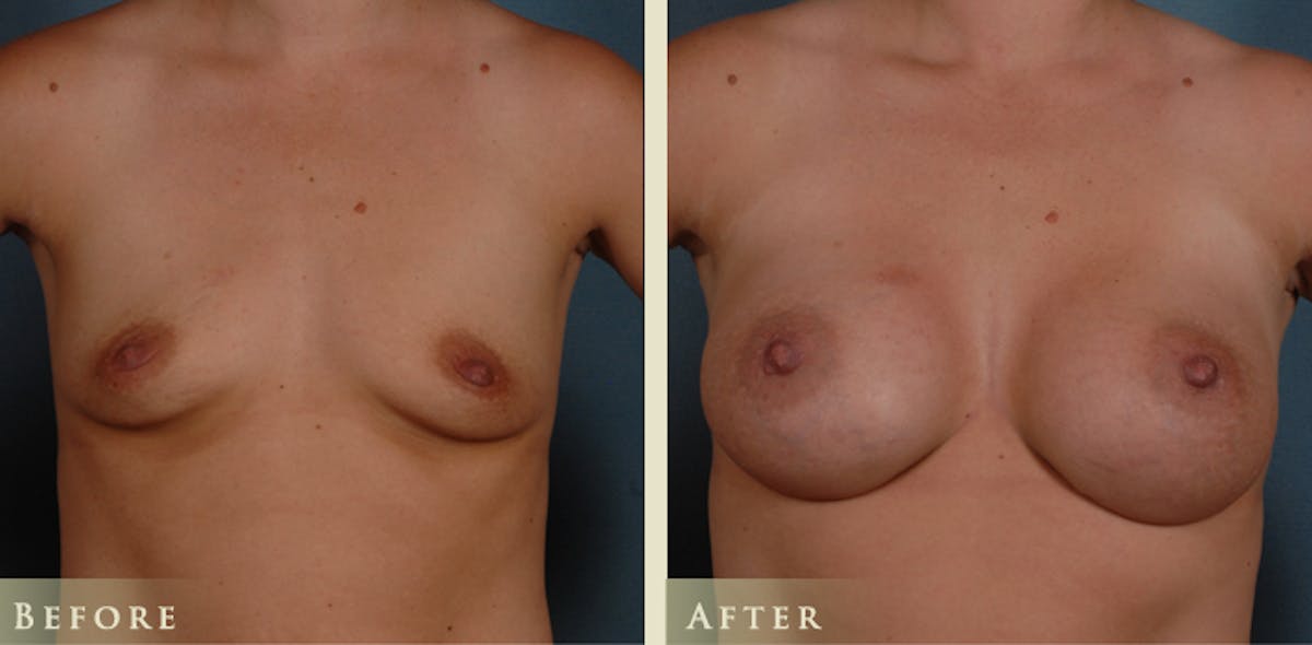 Breast Augmentation with Silicone Implants Before & After Gallery - Patient 105029 - Image 1
