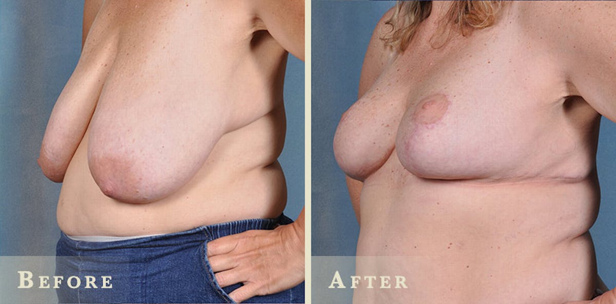 Breast Lift and Reduction Before & After Gallery - Patient 422628 - Image 3