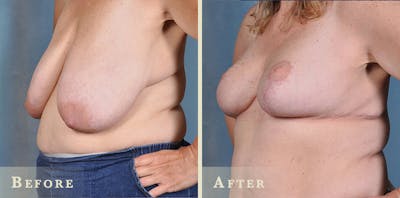 Breast Reduction Before & After Gallery - Patient 286092 - Image 3