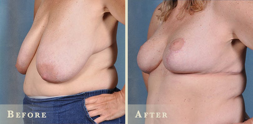 Breast Reduction Before & After Gallery - Patient 286092 - Image 3