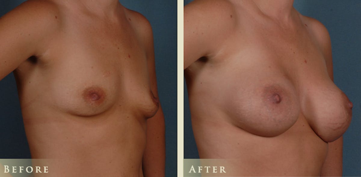 Breast Augmentation with Silicone Implants Before & After Gallery - Patient 105029 - Image 2