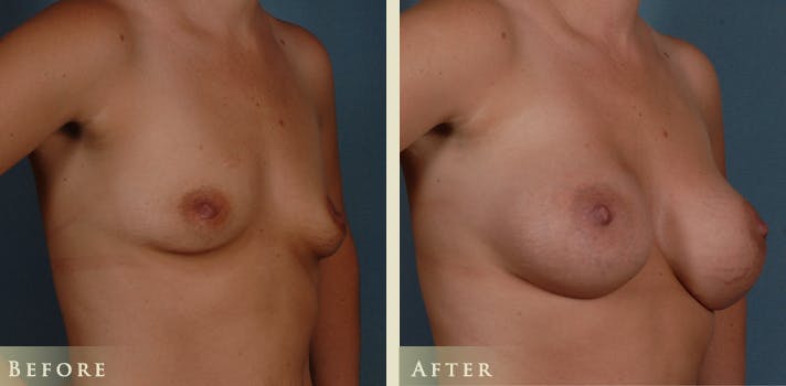 Breast Augmentation Before & After Gallery - Patient 105029 - Image 2