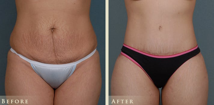 Tummy Tuck Before & After Gallery - Patient 274234 - Image 1