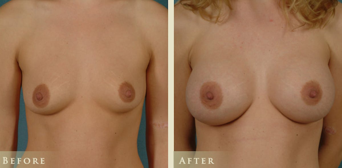 Breast Augmentation with Saline Implants Before & After Gallery - Patient 421081 - Image 1