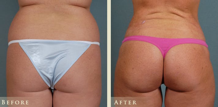 Brazilian Butt Lift Before & After Gallery - Patient 265057 - Image 1