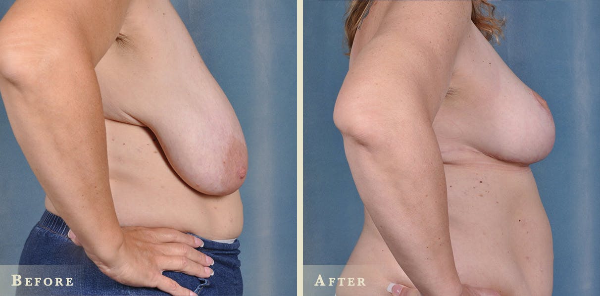 Breast Reduction Before & After Gallery - Patient 286092 - Image 4