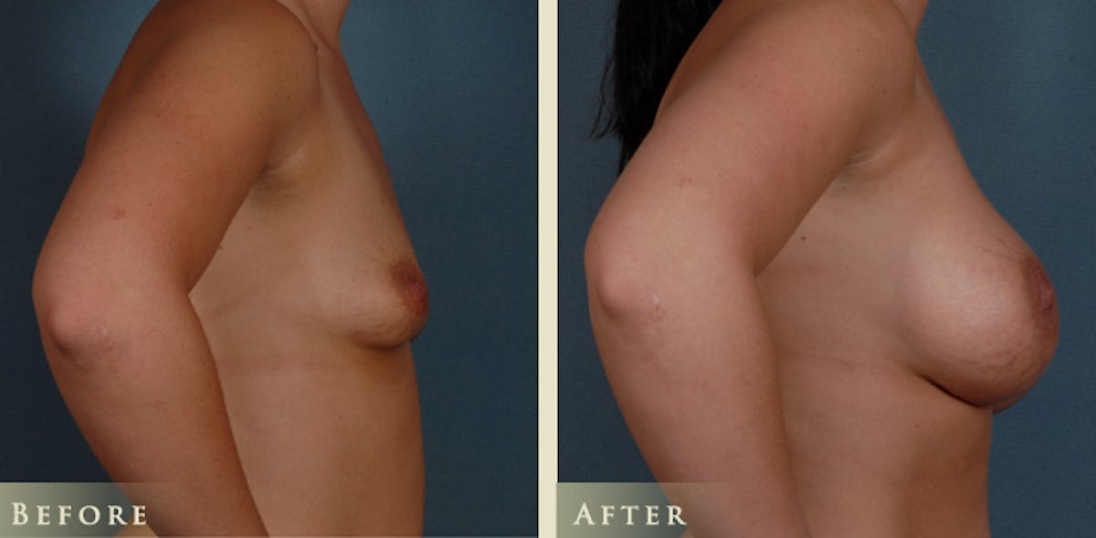 Breast Augmentation with Silicone Implants Before & After Gallery - Patient 105029 - Image 3