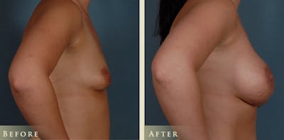 Breast Augmentation Before & After Gallery - Patient 105029 - Image 3
