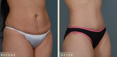 Tummy Tuck Before & After Gallery - Patient 274234 - Image 2