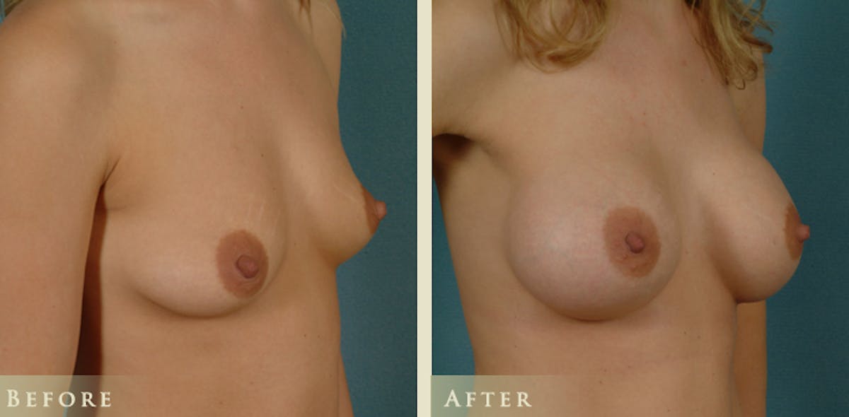 Breast Augmentation with Saline Implants Before & After Gallery - Patient 421081 - Image 2