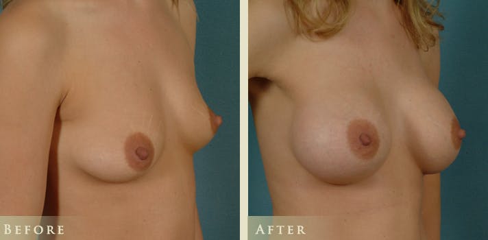 Breast Augmentation Before & After Gallery - Patient 131629 - Image 2
