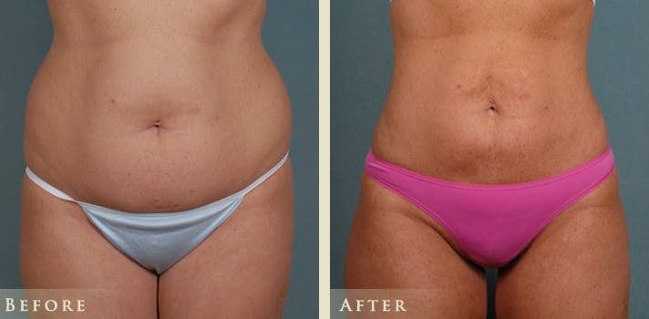 Brazilian Butt Lift Before & After Gallery - Patient 265057 - Image 2