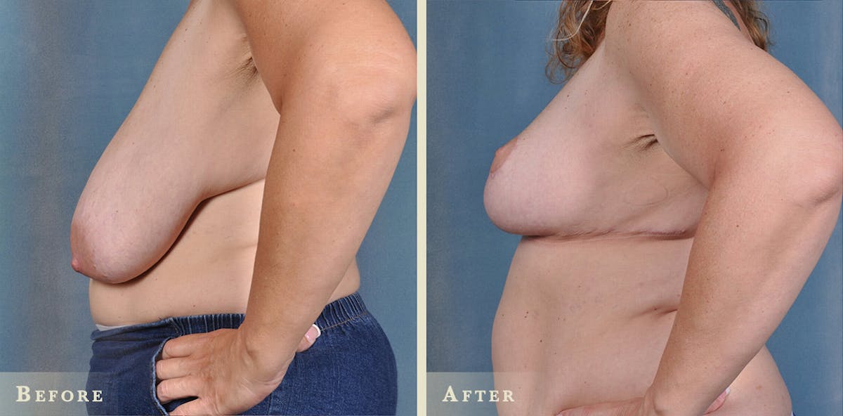 Breast Lift and Reduction Before & After Gallery - Patient 422628 - Image 5