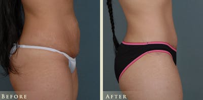 Tummy Tuck Before & After Gallery - Patient 274234 - Image 3