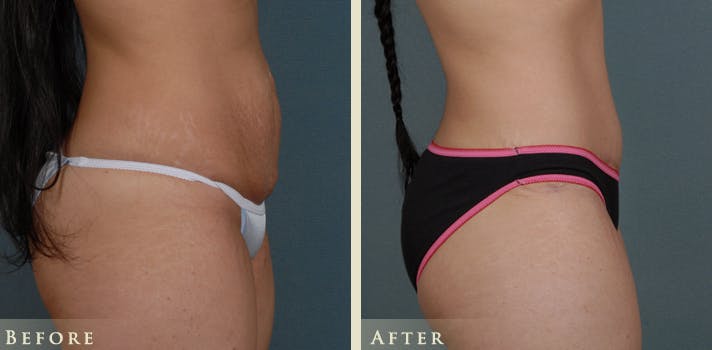 Tummy Tuck Before & After Gallery - Patient 274234 - Image 3