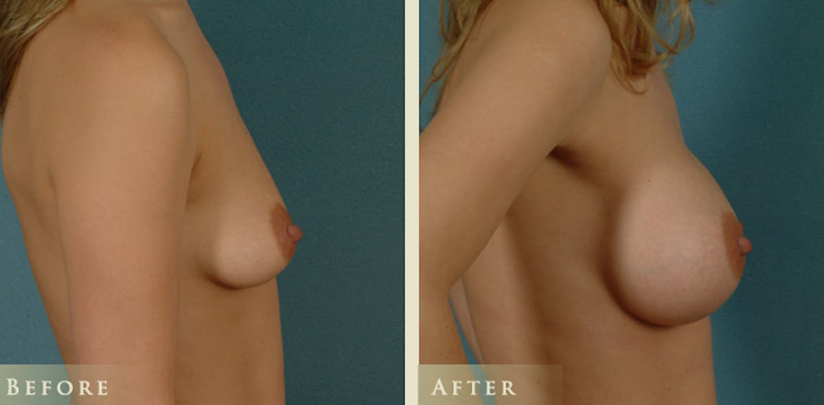 Breast Augmentation with Saline Implants Before & After Gallery - Patient 421081 - Image 3