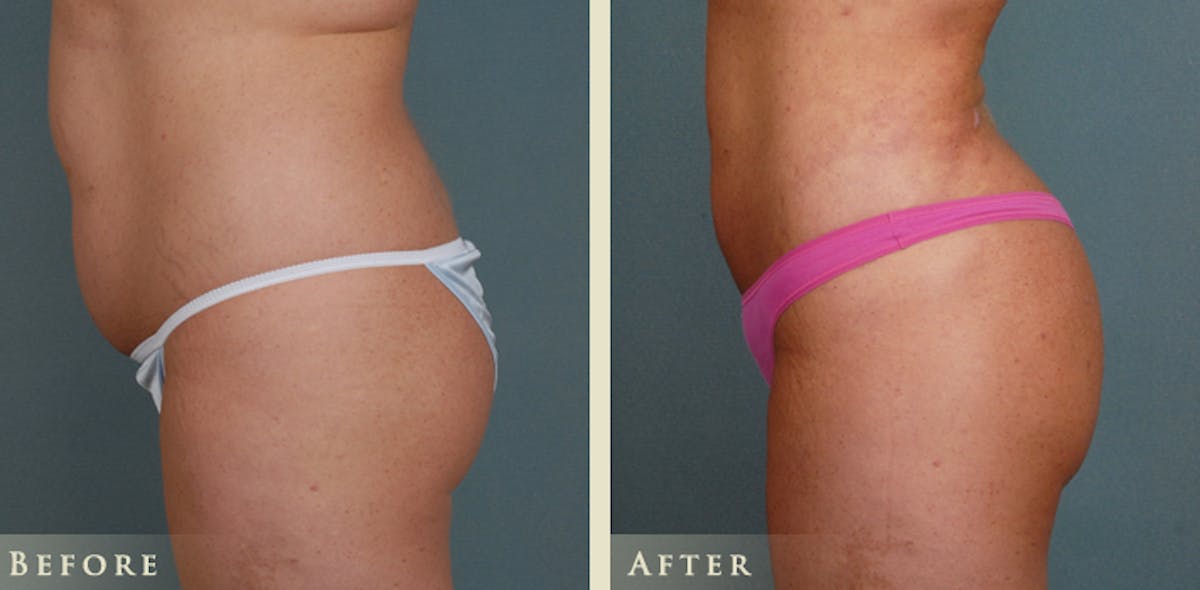 Brazilian Butt Lift Before & After Gallery - Patient 265057 - Image 3