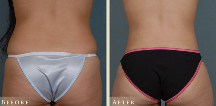 Tummy Tuck Before & After Gallery - Patient 274234 - Image 4