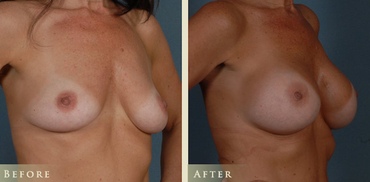 Breast Augmentation with Silicone Implants Before & After Gallery - Patient 441814 - Image 2