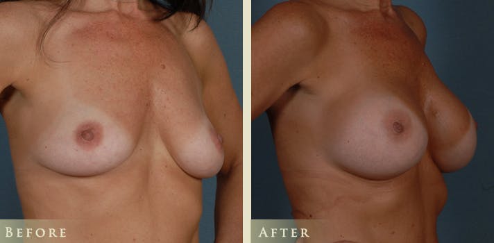 Breast Augmentation Before & After Gallery - Patient 441814 - Image 2