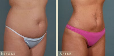 Brazilian Butt Lift Before & After Gallery - Patient 265057 - Image 4