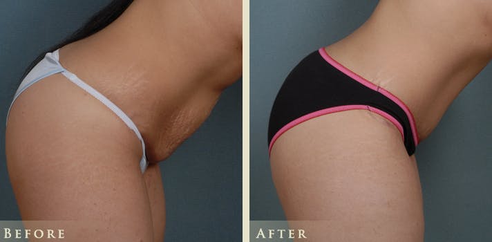 Tummy Tuck Before & After Gallery - Patient 274234 - Image 5