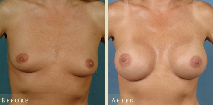 Breast Augmentation Before & After Gallery - Patient 262686 - Image 1