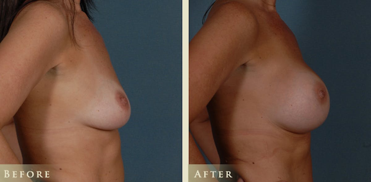 Breast Augmentation with Silicone Implants Before & After Gallery - Patient 441814 - Image 3