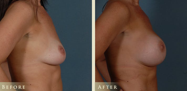Breast Augmentation Before & After Gallery - Patient 441814 - Image 3