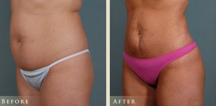 Brazilian Butt Lift Before & After Gallery - Patient 265057 - Image 5