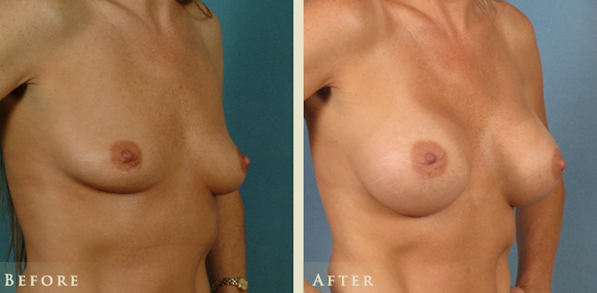 Breast Augmentation with Saline Implants Before & After Gallery - Patient 740604 - Image 2