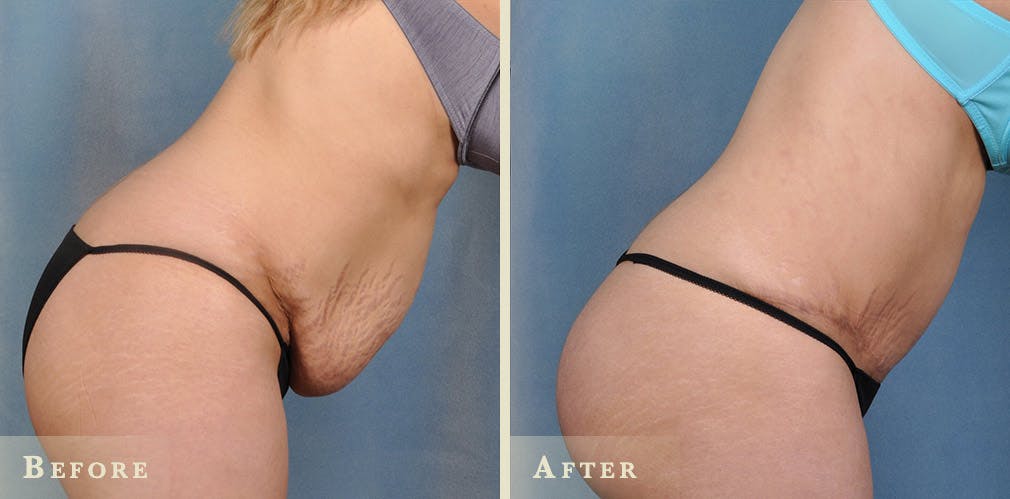 Female Liposuction Before & After Gallery - Patient 401950 - Image 5