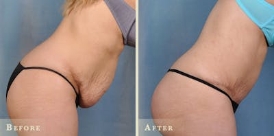 Female Liposuction Before & After Gallery - Patient 401950 - Image 5
