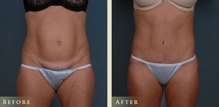 Tummy Tuck Before & After Gallery - Patient 363444 - Image 1