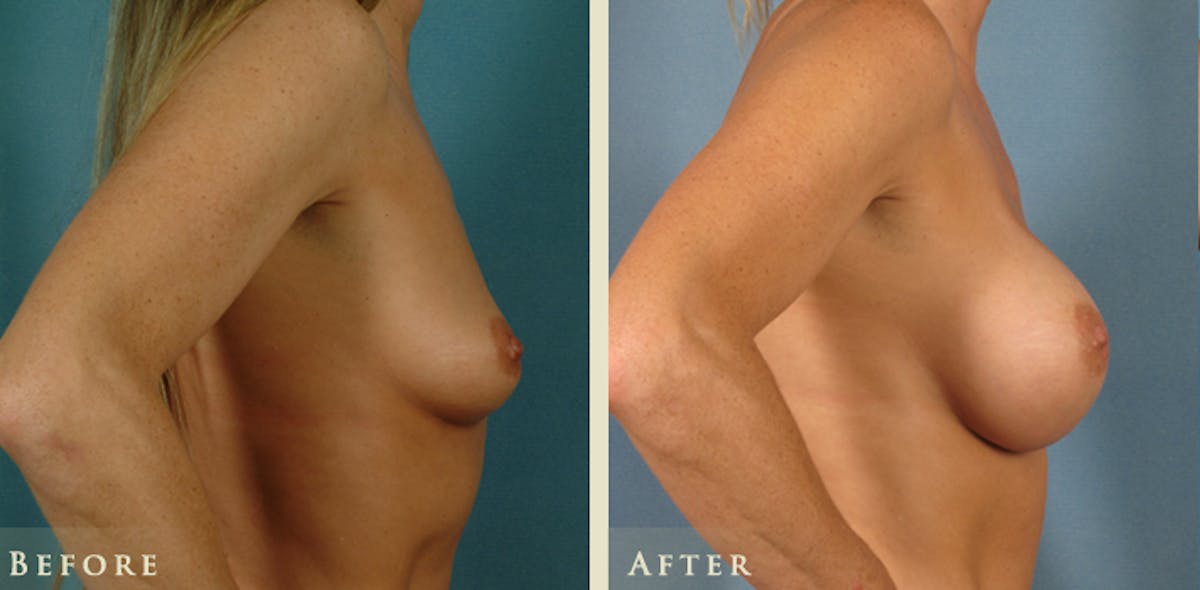 Breast Augmentation with Saline Implants Before & After Gallery - Patient 740604 - Image 3