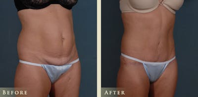 Tummy Tuck Before & After Gallery - Patient 363444 - Image 2
