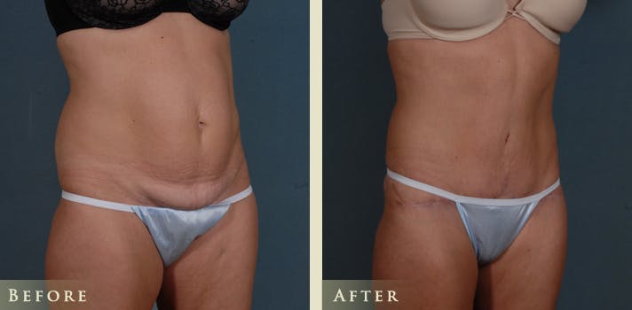 Tummy Tuck Before & After Gallery - Patient 363444 - Image 2