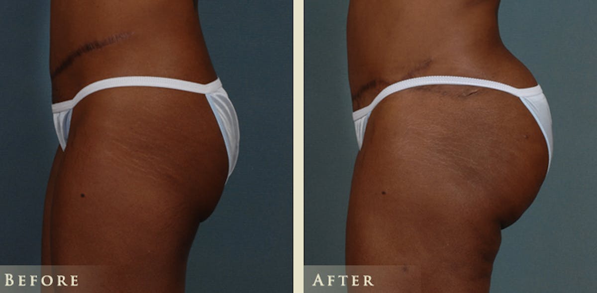 Brazilian Butt Lift Before & After Gallery - Patient 334375 - Image 1