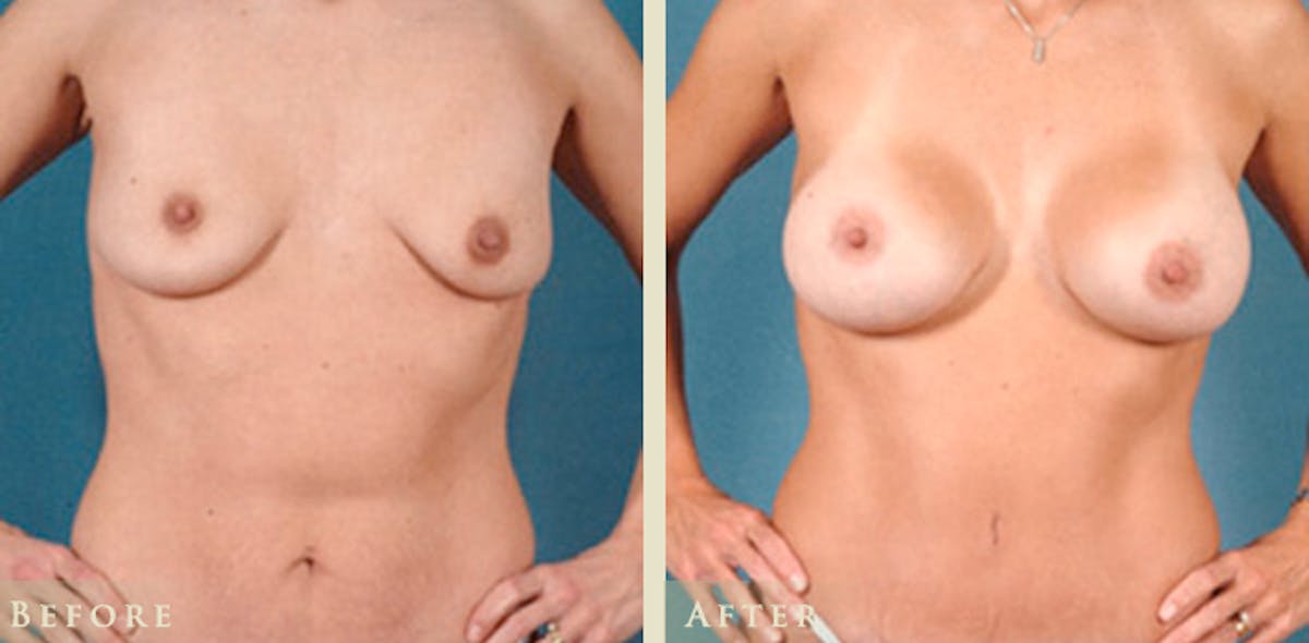 Breast Augmentation with Silicone Implants Before & After Gallery - Patient 139731 - Image 1