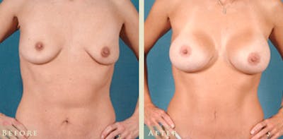 Breast Augmentation Before & After Gallery - Patient 139731 - Image 1