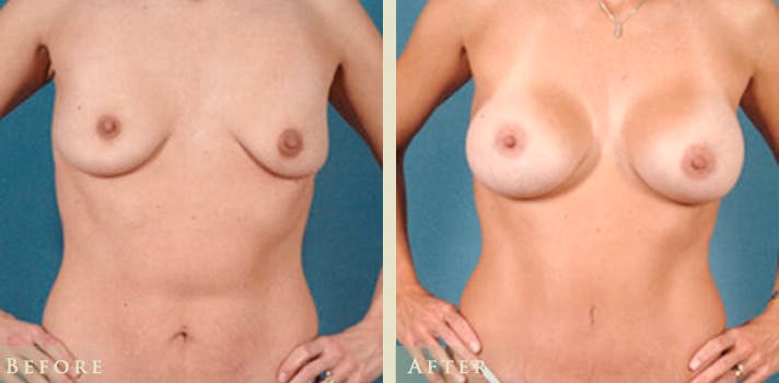 Breast Augmentation Before & After Gallery - Patient 139731 - Image 1