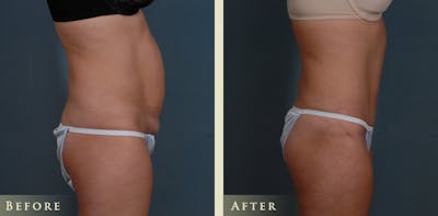 Tummy Tuck Before & After Gallery - Patient 363444 - Image 3